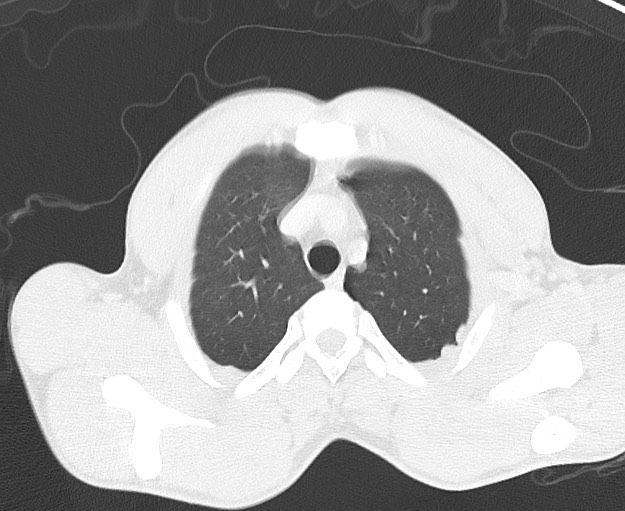 Arrow injury to the chest (Radiopaedia 75223-86321 Axial lung window 2).jpg
