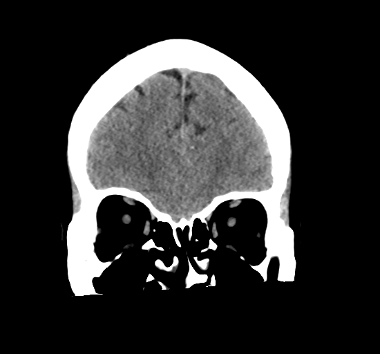 File:Arteriovenous malformation (cerebral) (Radiopaedia 40070-42579 Coronal non-contrast 9).png