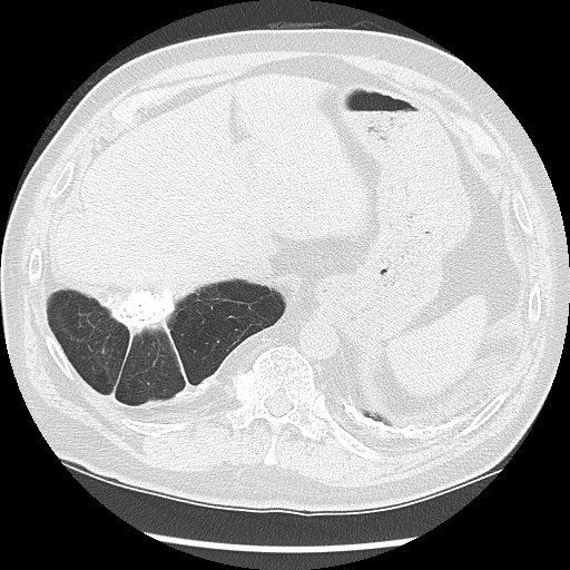 Asbestos-related pleural disease (Radiopaedia 74366-85250 Axial lung window 100).jpg