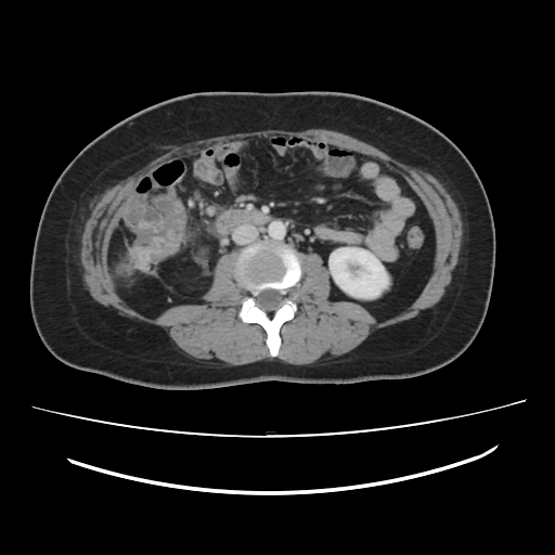 Ascending retrocecal appendicitis with liver abscesses (Radiopaedia 60066-67615 B 48).jpg