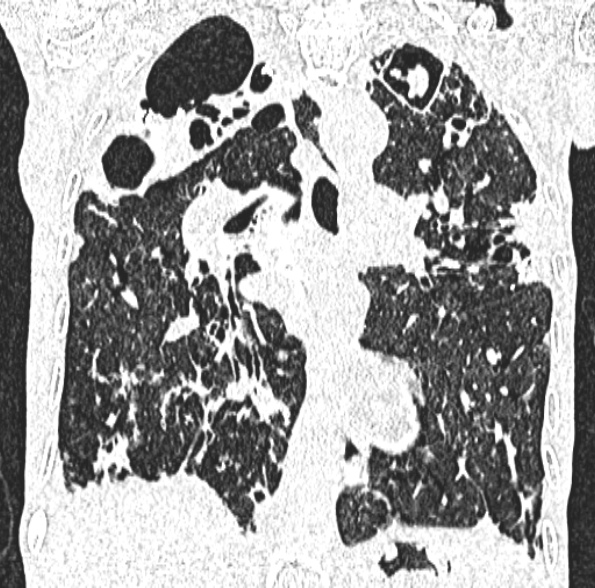 Aspergilloma- with Monod sign (Radiopaedia 44737-48532 Coronal lung window 259).jpg