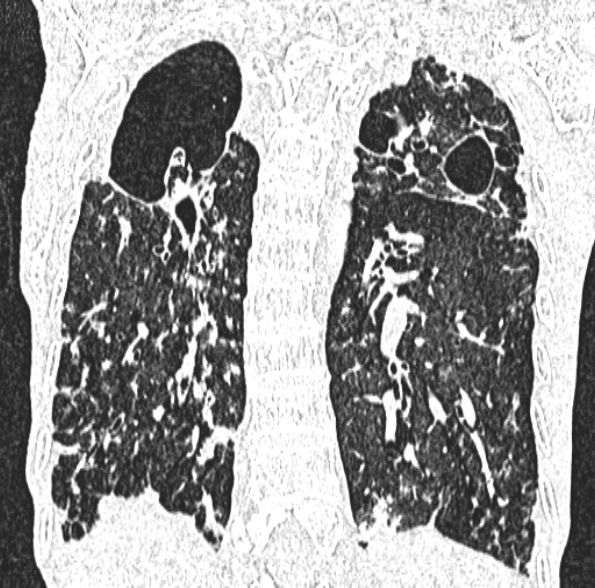 Aspergilloma- with Monod sign (Radiopaedia 44737-48532 Coronal lung window 330).jpg
