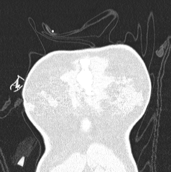 File:Aspergilloma (Radiopaedia 26223-26347 Coronal lung window 3).jpg