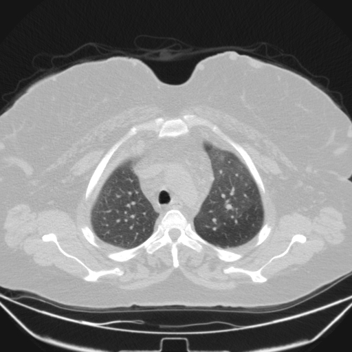 Aspergilloma (Radiopaedia 39611-41932 Axial lung window 25).jpg