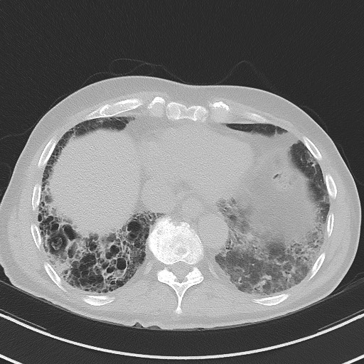 Aspergilloma on background pulmonary fibrosis (Radiopaedia 60942-68757 A 43).jpg