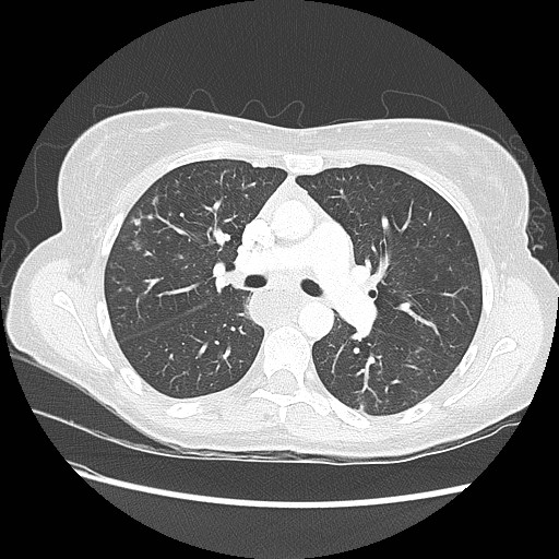 Aspiration pneumonia secondary to laparoscopic banding (Radiopaedia 18345-18183 lung window 44).jpg