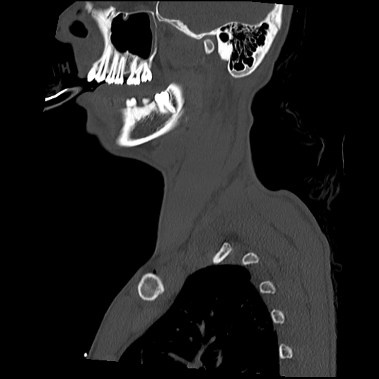 Atlanto-occipital dissociation (Traynelis type 1), C2 teardrop fracture, C6-7 facet joint dislocation (Radiopaedia 87655-104061 Sagittal bone window 11).jpg