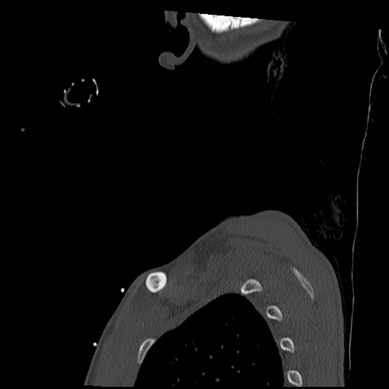 Atlanto-occipital dissociation (Traynelis type 1), C2 teardrop fracture, C6-7 facet joint dislocation (Radiopaedia 87655-104061 Sagittal bone window 71).jpg