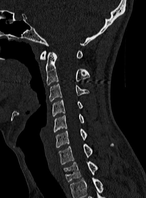 Atlantoaxial subluxation (Radiopaedia 44681-48450 Sagittal bone window 64).jpg