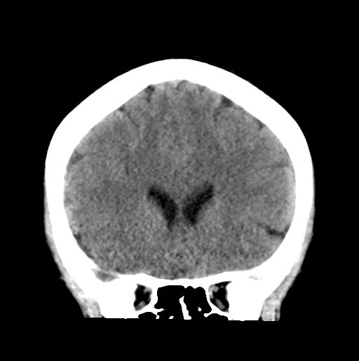File:Atretic encephalocoele with inferior vermis hypoplasia (Radiopaedia 30443-31107 Coronal non-contrast 14).jpg