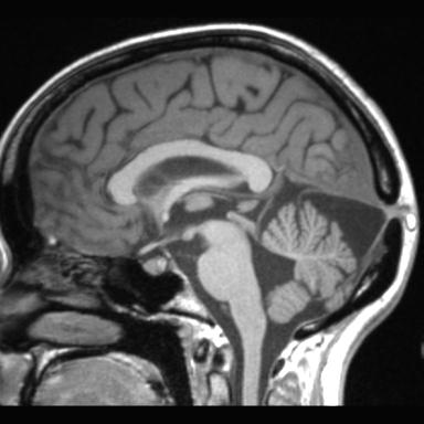 Atretic encephalocoele with inferior vermis hypoplasia (Radiopaedia 30443-31108 Sagittal T1 65).jpg