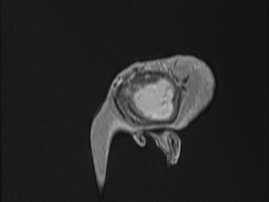 Atypical meningioma (Radiopaedia 62985-71406 Sagittal T1 C+ 105).jpg