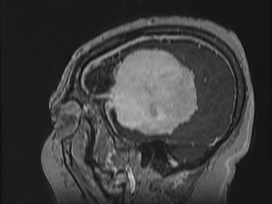 Atypical meningioma (Radiopaedia 62985-71406 Sagittal T1 C+ 81).jpg