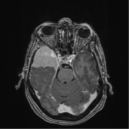 Atypical meningioma (WHO Grade II) (Radiopaedia 54742-60979 Axial T1 C+ 20).png