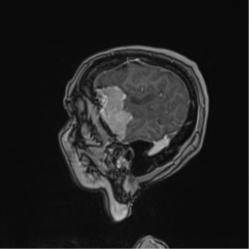 Atypical meningioma (WHO Grade II) (Radiopaedia 54742-60979 Sagittal T1 C+ 63).png