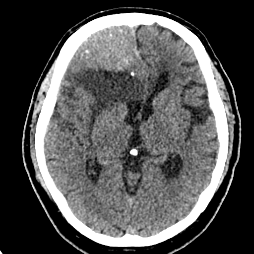 File:Atypical meningioma (WHO grade II) with brain invasion (Radiopaedia 57767-64728 Axial non-contrast 20).png