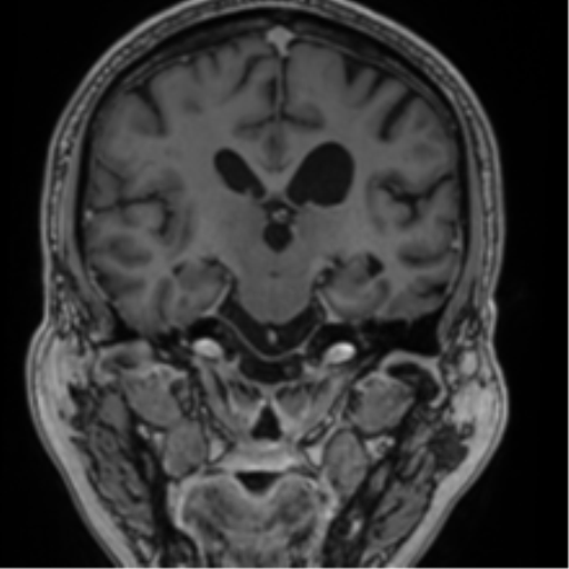 File:Atypical meningioma (WHO grade II) with brain invasion (Radiopaedia 57767-64729 Coronal T1 C+ 46).png