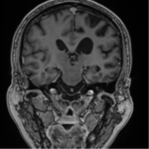 File:Atypical meningioma (WHO grade II) with brain invasion (Radiopaedia 57767-64729 Coronal T1 C+ 47).png