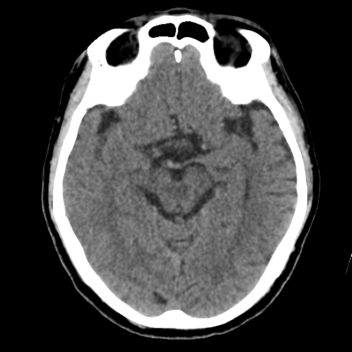 File:Atypical meningioma (WHO grade II) with osseous invasion (Radiopaedia 53654-59715 Axial non-contrast 23).png