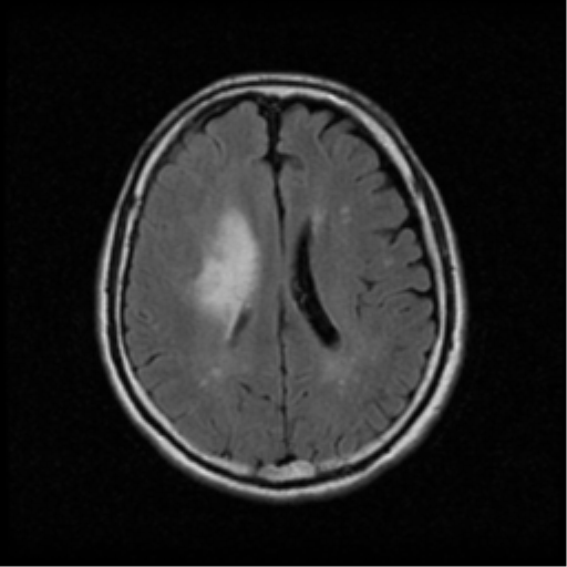 File:Atypical meningioma with skull invasion (Radiopaedia 34357-35648 Axial FLAIR 14).png