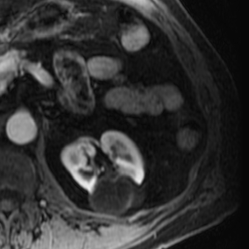 File:Atypical renal cyst on MRI (Radiopaedia 17349-17046 C 12).jpg