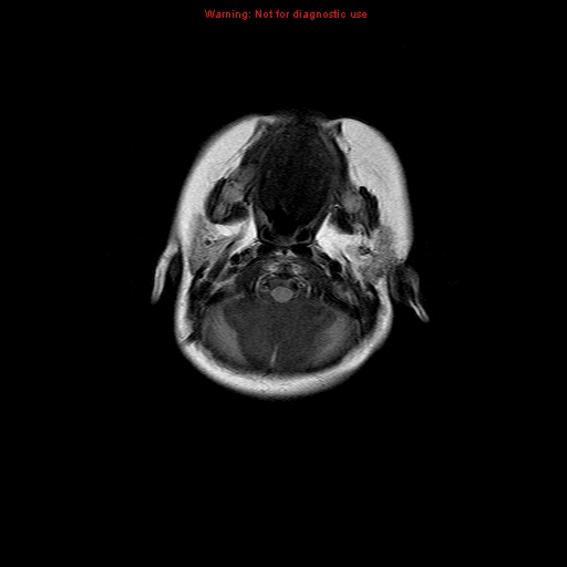 File:Atypical teratoid rhabdoid tumor (Radiopaedia 10712-11183 Axial FLAIR 17).jpg