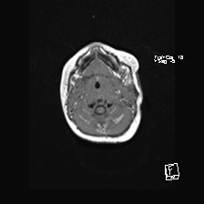 Atypical teratoid rhabdoid tumor (prenatal US and neonatal MRI) (Radiopaedia 59091-66388 Axial T1 3).jpg