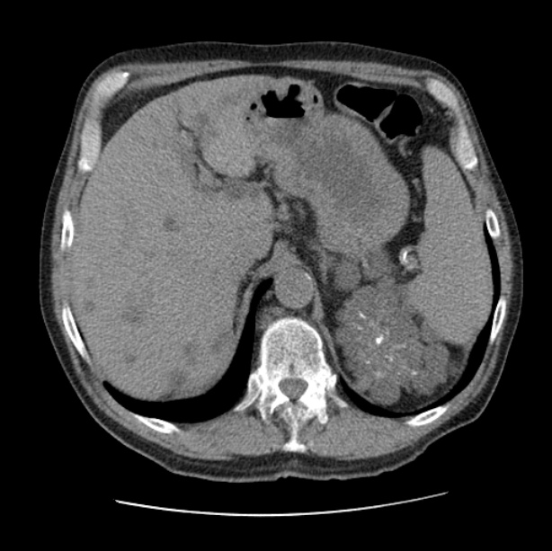Autosomal dominant polycystic kidney disease (Radiopaedia 27851-28094 Axial non-contrast 54).jpg