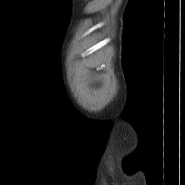 Autosomal dominant polycystic kidney disease (Radiopaedia 36539-38101 D 81).jpg