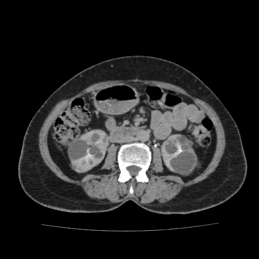 Autosomal dominant polycystic kidney disease (Radiopaedia 38189-40194 Axial C+ delayed 26).jpg