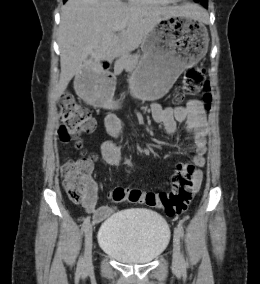 File:Autosomal dominant polycystic kidney disease (Radiopaedia 38189-40194 Coronal C+ delayed 22).jpg