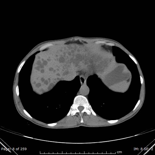 File:Autosomal dominant polycystic kidney disease (Radiopaedia 44122-47684 Axial non-contrast 3).jpg