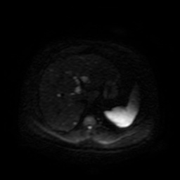 Autosomal dominant polycystic kidney disease (Radiopaedia 50259-55611 Axial DWI 47).jpg