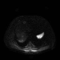 Autosomal dominant polycystic kidney disease (Radiopaedia 50259-55611 Axial DWI 77).jpg