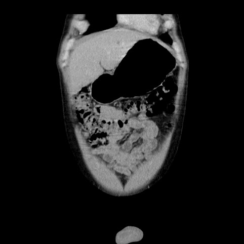 Autosomal dominant polycystic kidney disease (Radiopaedia 66349-75582 A 2).jpg