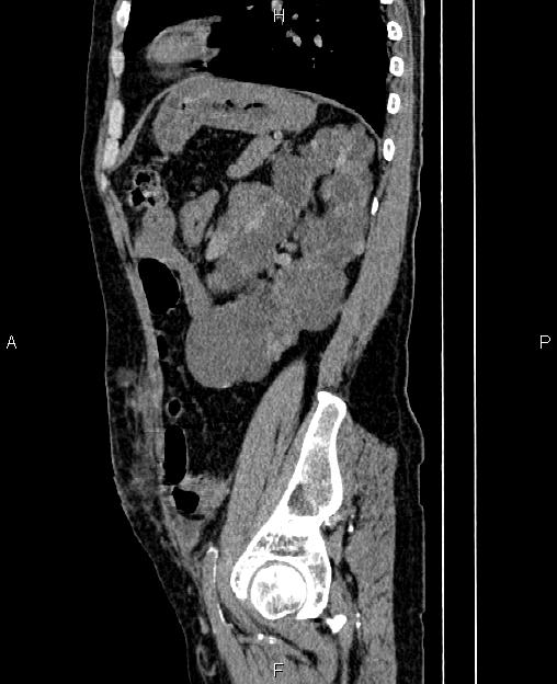 Autosomal dominant polycystic kidney disease (Radiopaedia 87830-104287 C 68).jpg