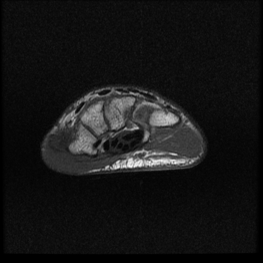 File:Avascular necrosis - scaphoid non-union (Radiopaedia 63457-72065 Axial T1 5).jpg