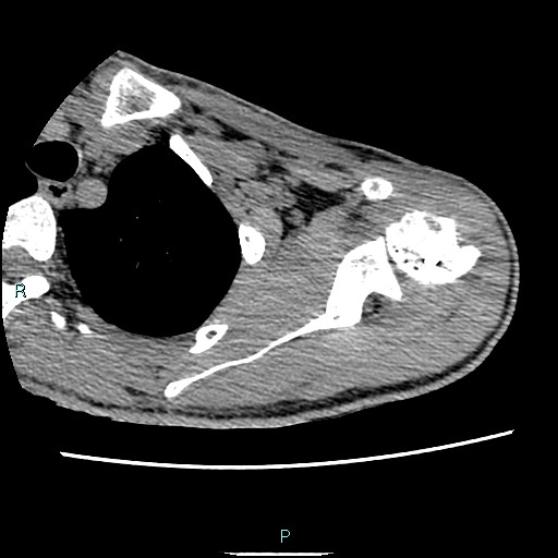 Avascular necrosis after fracture dislocations of the proximal humerus (Radiopaedia 88078-104653 D 32).jpg