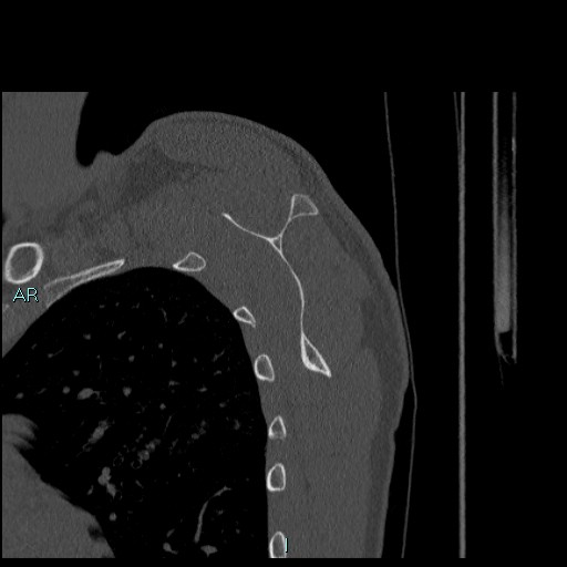 Avascular necrosis after fracture dislocations of the proximal humerus (Radiopaedia 88078-104655 Sagittal bone window 56).jpg