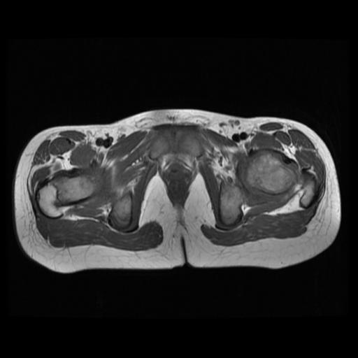 File:Avascular necrosis of the hip (Radiopaedia 29563-30067 Axial T1 12).jpg