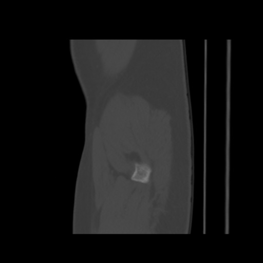 Avascular necrosis of the hip (Radiopaedia 61503-69467 B 2).jpg