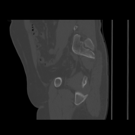 Avascular necrosis of the hip (Radiopaedia 61503-69467 B 22).jpg