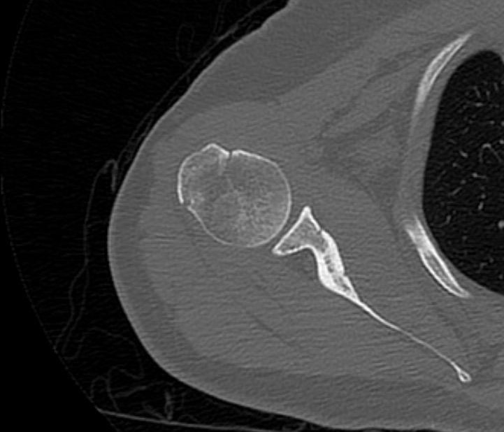 Avulsion fracture - greater tuberosity of humerus (Radiopaedia 71216-81514 Axial bone window 36).jpg