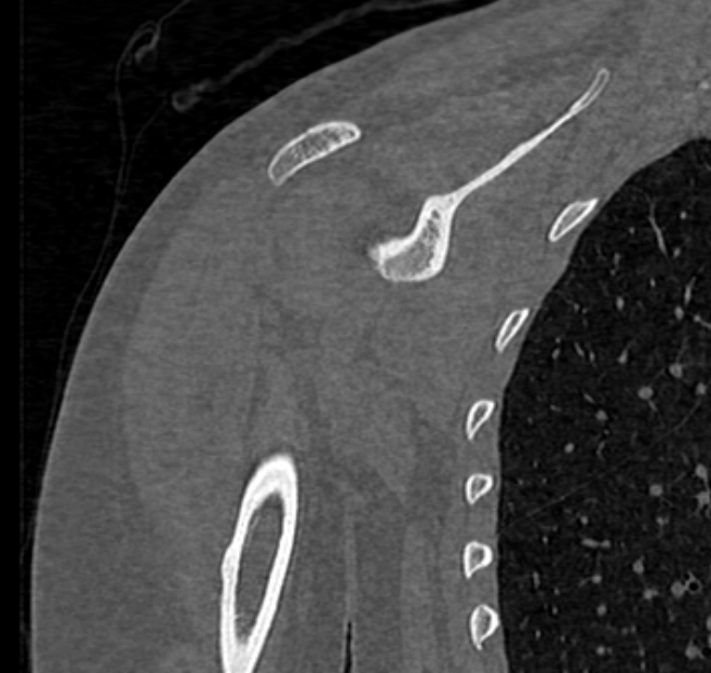 Avulsion fracture - greater tuberosity of humerus (Radiopaedia 71216-81514 Coronal bone window 41).jpg