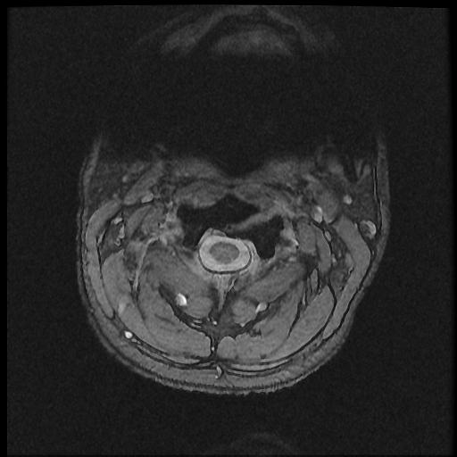 File:Axis fracture - MRI (Radiopaedia 71925-82375 Axial T2 fat sat 3).jpg