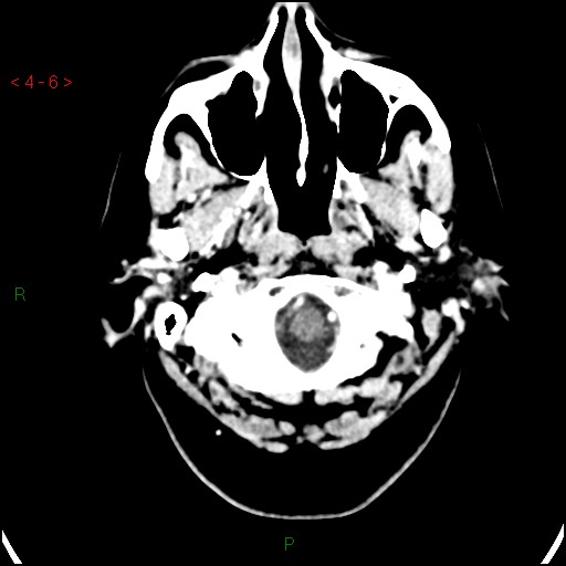 Azygos anterior cerebral artery (Radiopaedia 51987-57833 A 6).jpg
