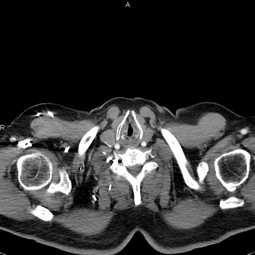 File:Azygos continuation of the inferior vena cava (Radiopaedia 18537-18404 C+ arterial phase 1).jpg