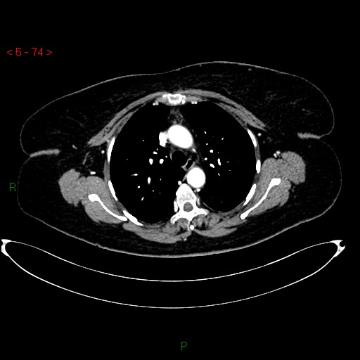 Azygos fissure and lobe (Radiopaedia 47620-52278 A 60).jpg