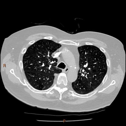 Azygos lobe (Radiopaedia 40161-42821 Axial lung window 22).jpg
