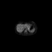 B-cell lymphoma of the mesentery (Radiopaedia 65743-74868 18F-FDG PET-CT 176).jpg